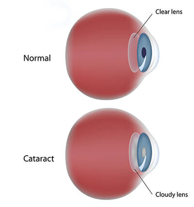 Cataracts Los Altos